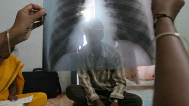 tuberculosis (1)